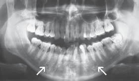 figure 2 panoramic radiograph showing the relationship between the mental foramina and the mandibular premolars