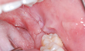 ulcère buccal ganglion enflé ulcère buccal ganglion enflé