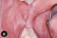 levre de la bouche qui gonfle levre de la bouche qui gonfle