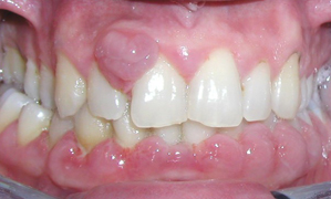 idiopathic gingival hyperplasia clinical features and differential gingival hyperplasia