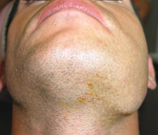 infection dentaire ganglion machoire infection dentaire ganglion machoire