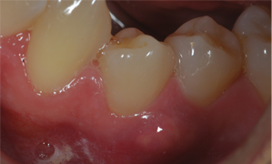 identification of an odontogenic keratocyst and treatment with odontogenic keratocyst