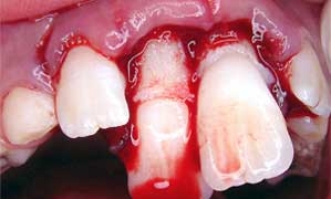 tooth luxation