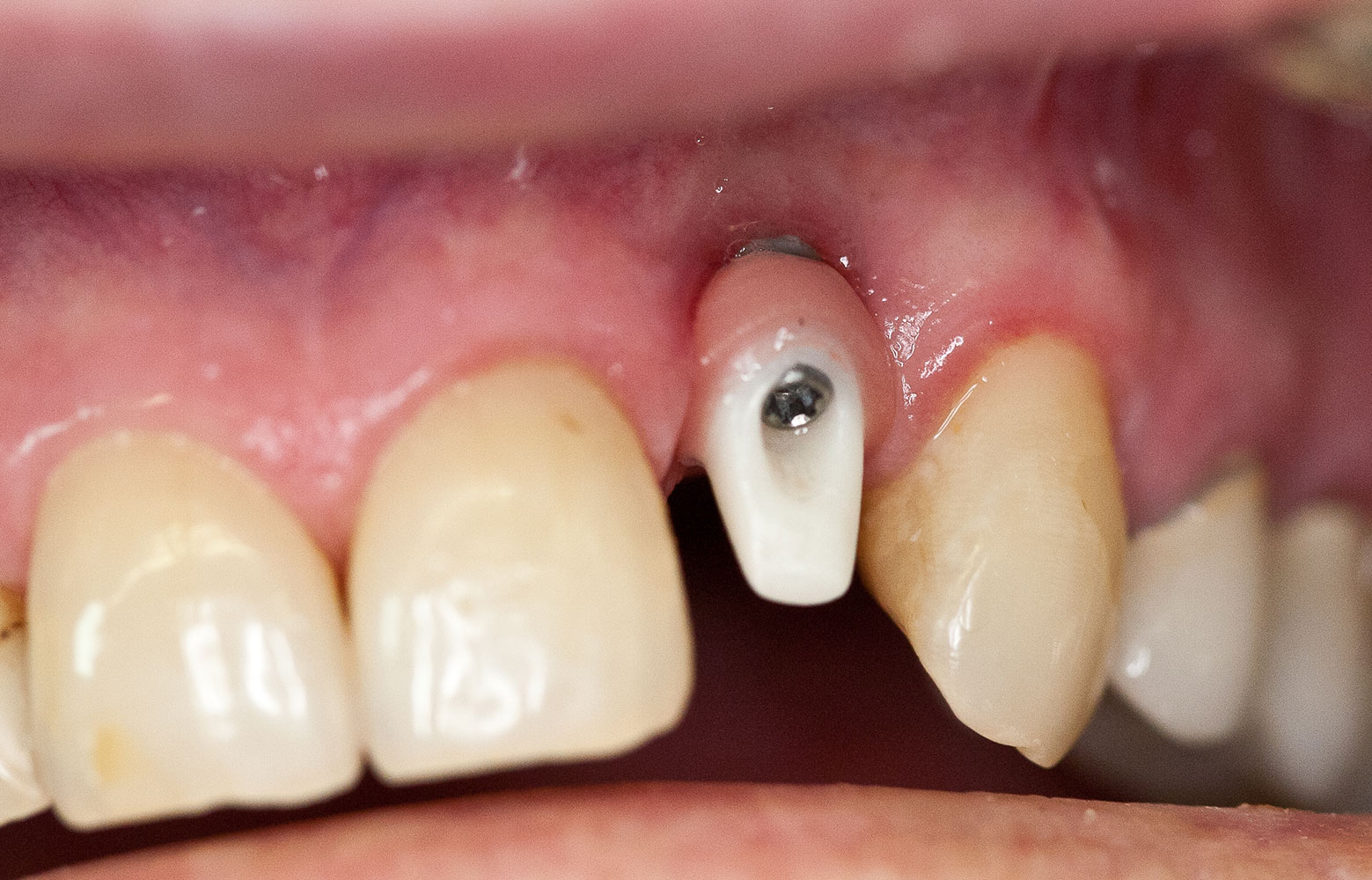Utilisation de porcelaine rose pour le traitement d’un implant