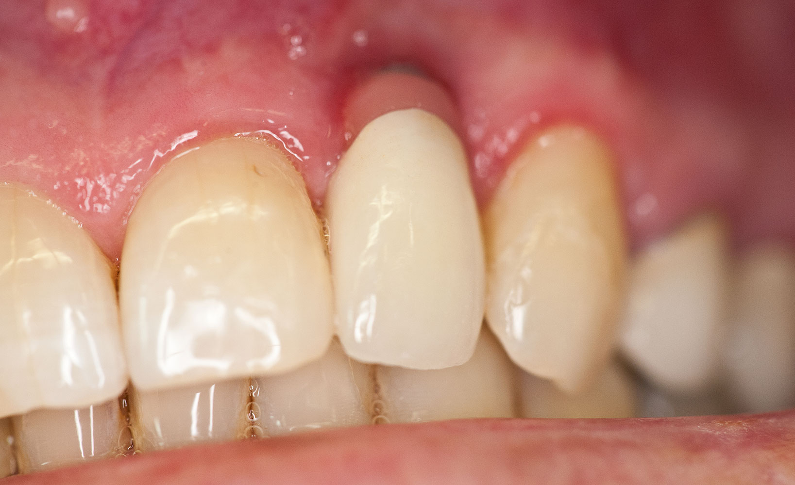 The Use of Pink Porcelain to Manage a Malposed Anterior Implant Case