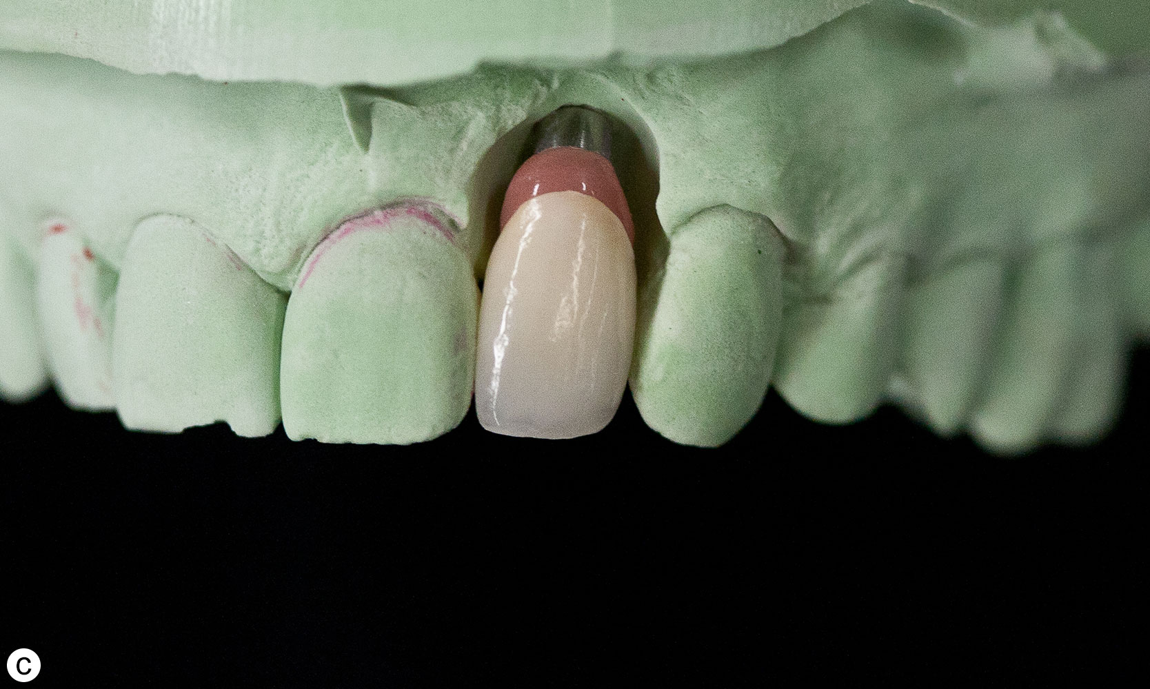 The Use of Pink Porcelain to Manage a Malposed Anterior Implant Case