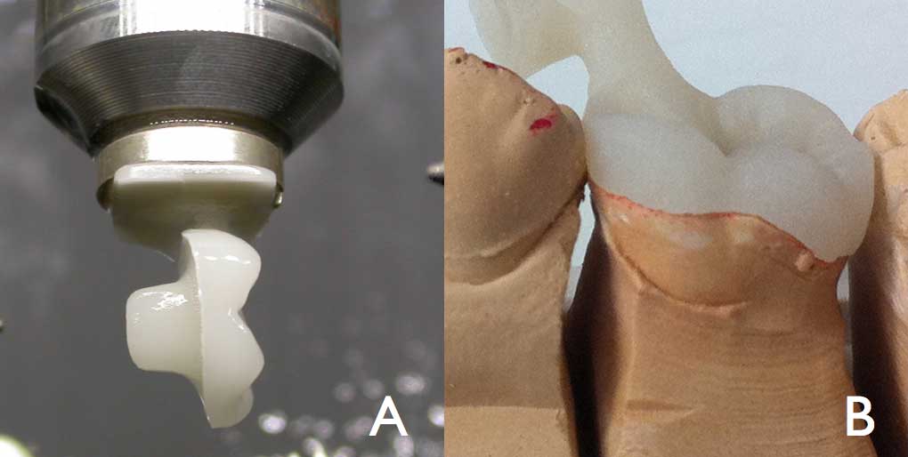 The Endocrown A Different Type of AllCeramic Reconstruction for