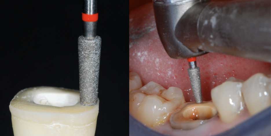 The Endocrown: A Different Type of All-Ceramic Reconstruction for