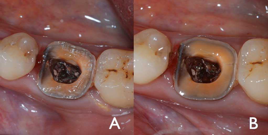 The Endocrown A Different Type of AllCeramic Reconstruction for