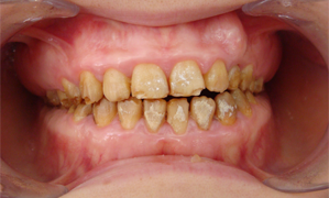 functional and esthetic rehabilitation of a patient with amelogenesis imperfecta