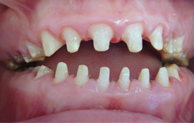 functional and esthetic rehabilitation of a patient with amelogenesis imperfecta jcda