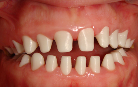 fig 5 intraoral view during test positioning of the copings