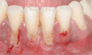 gingivite douleur atroce gingivite douleur atroce