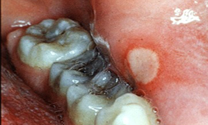 ulcération de la bouche ulcération de la bouche