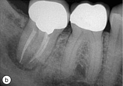 Bilateral Facial Numbness 22