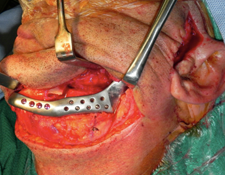 Reconstruction of the Temporomandibular Joint After Surgical Ablation