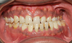 severe unilateral cross bite secondary to tumour of the mandibular crossbite