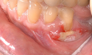 infection des gencives que faire infection des gencives que faire
