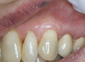 managing patients with gingival graft failure or loss jcda gingival recession