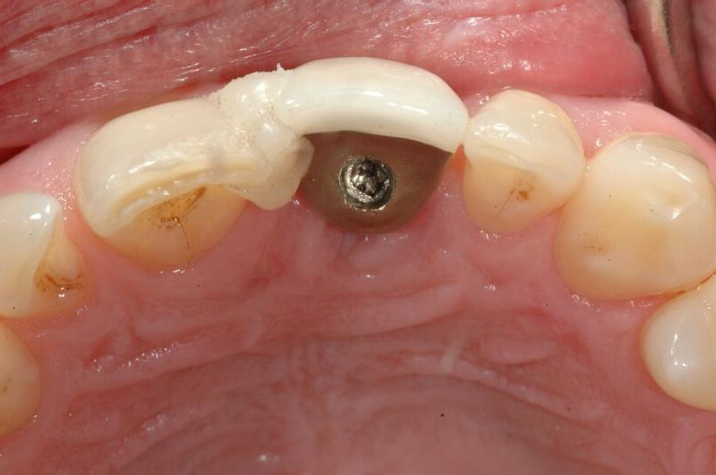 Managing Patients with a Loose Implant Abutment Screw jcda