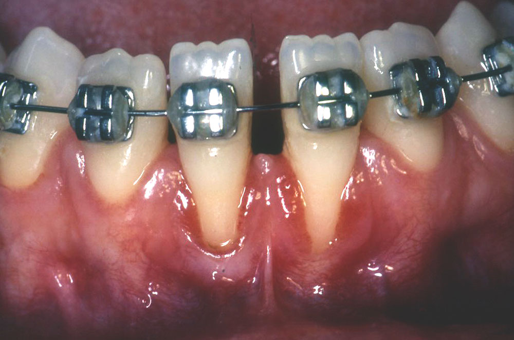 Unexpected Soft Tissue Changes in Response to Root Coverage Using an